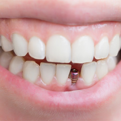 Zubné implantáty a ich variácie